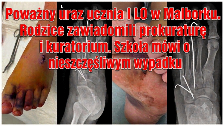 Poważny uraz ucznia I LO w Malborku. Rodzice zawiadomili prokuraturę…